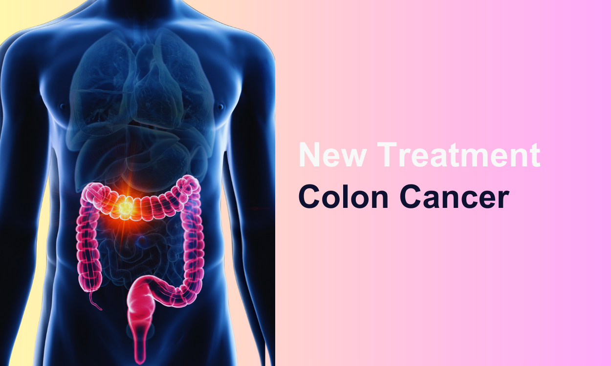 Excellent Outcome in a Young Stage-4 Colon Cancer with new Treatment